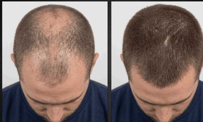 HaloGrow Hair Spray Male Reviews2