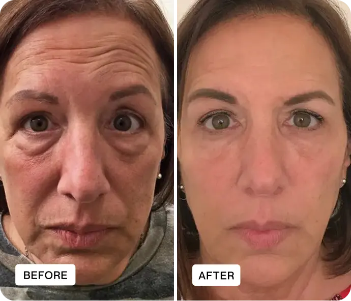 Renewa EyeLift Reviews