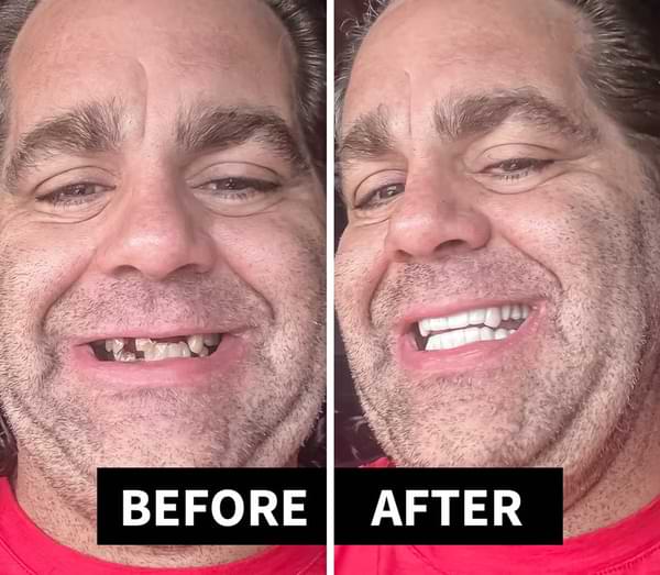 Shiny Smile Veneers Reviews1