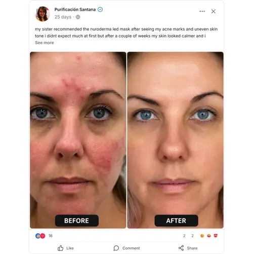 NuroDerma LED Light Mask Reviews 8